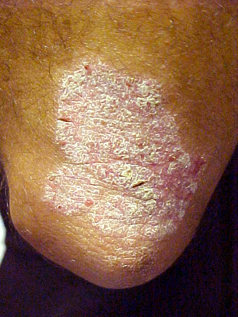 psoriasis
