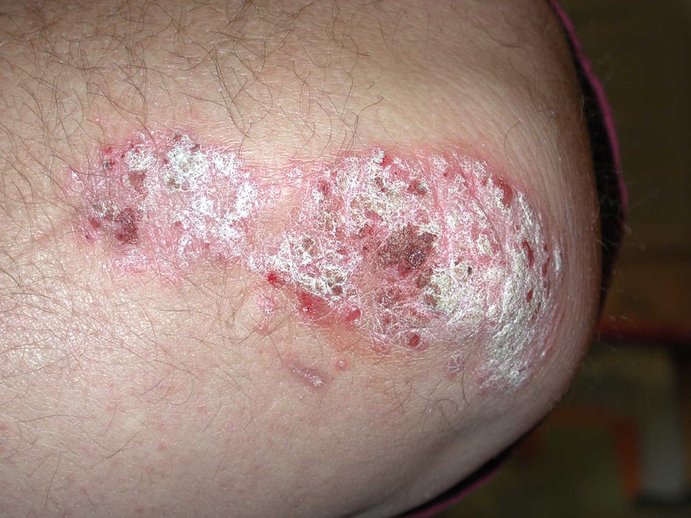 psoriasis