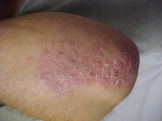 psoriasis
