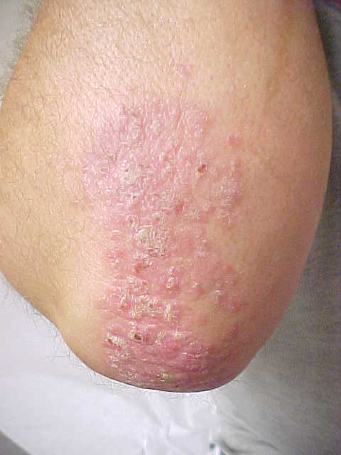 psoriasis