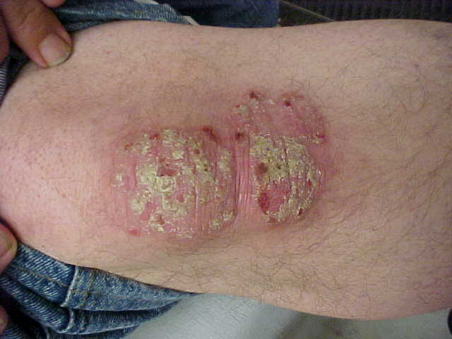 psoriasis