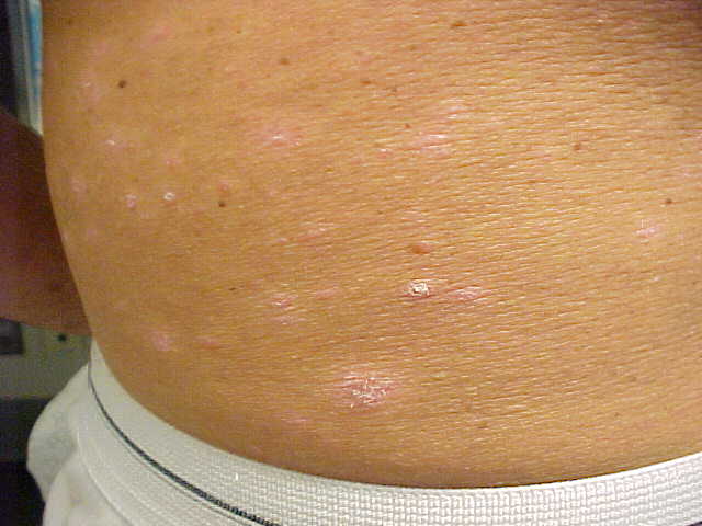 psoriasis