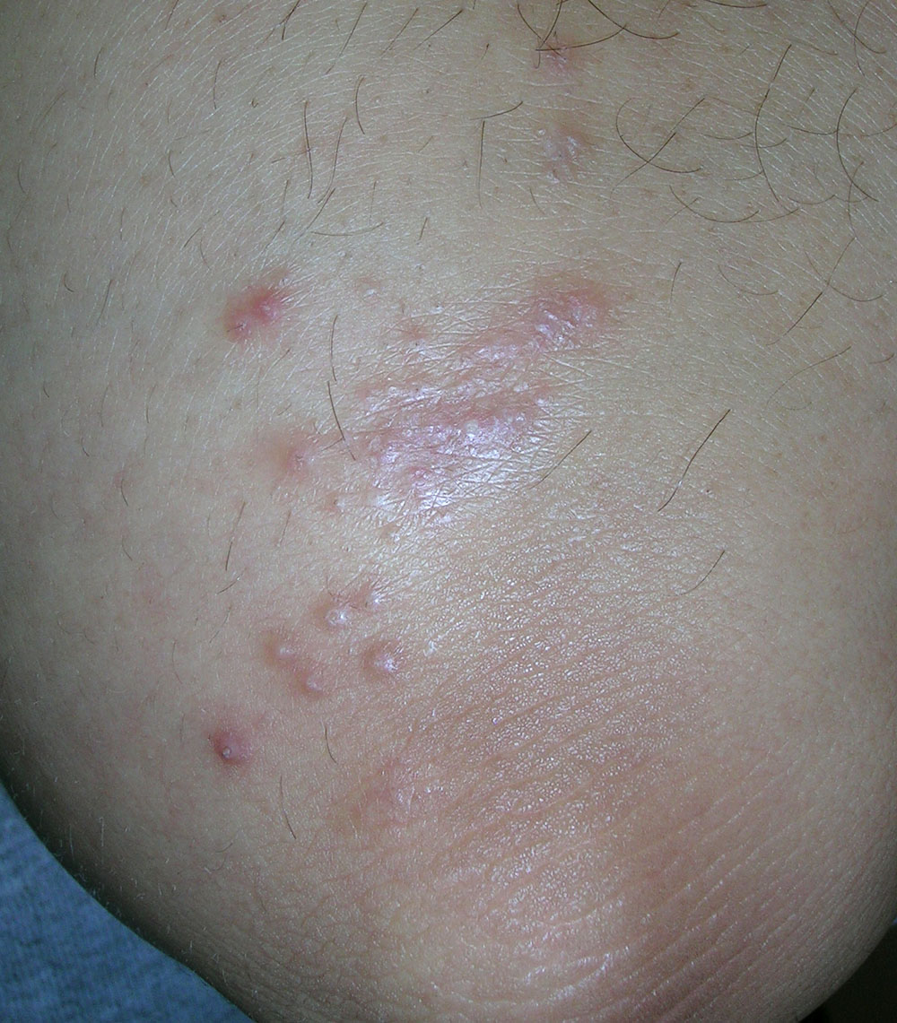 psoriasis