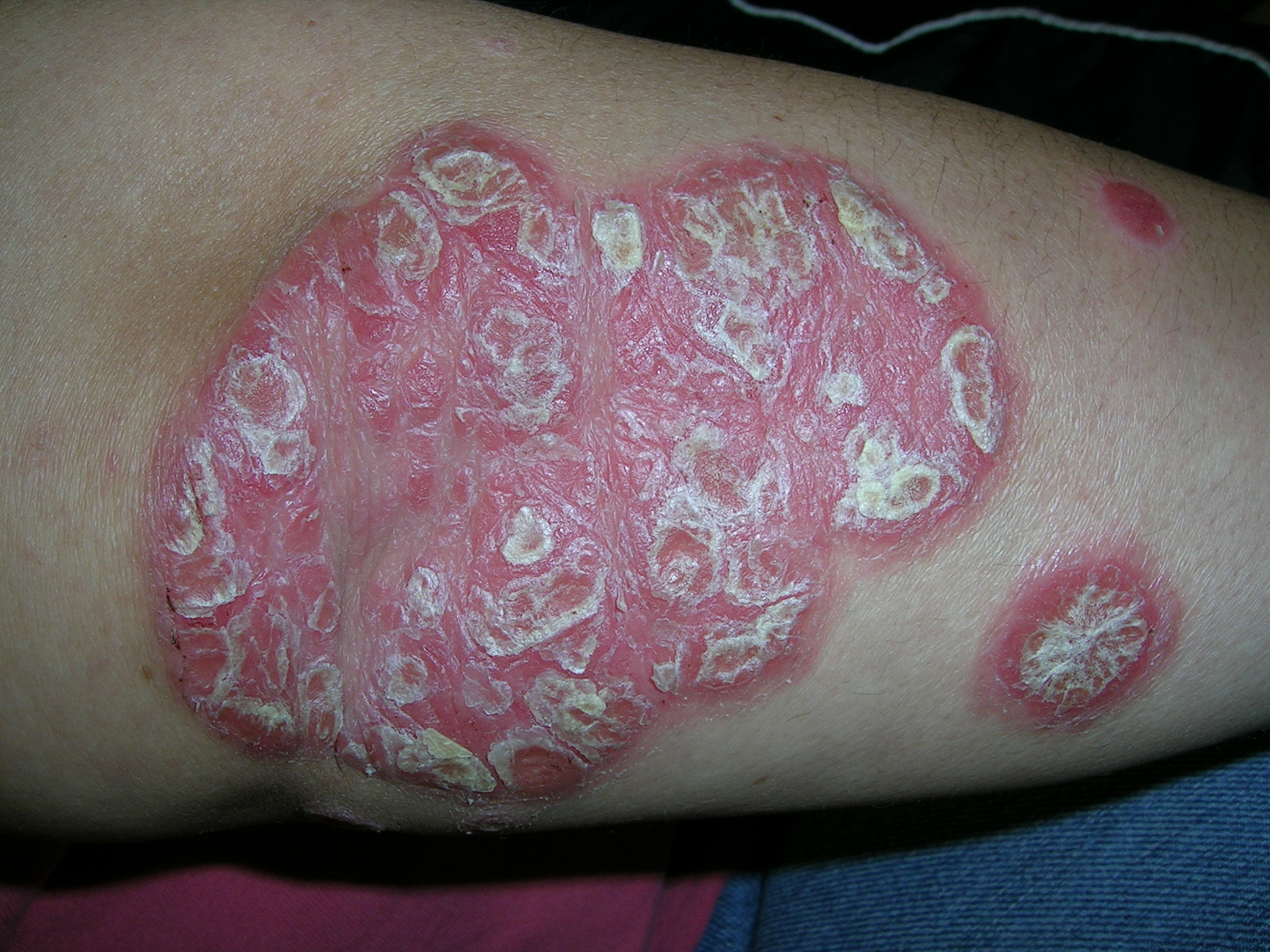 psoriasis