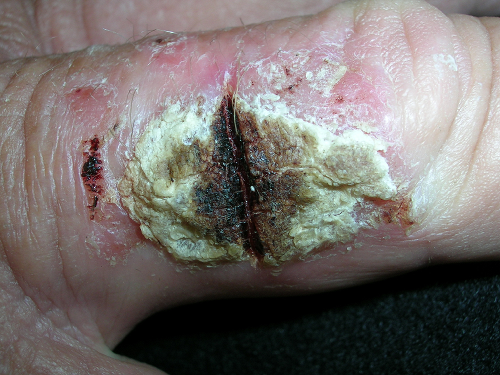 squamous cell carcinoma