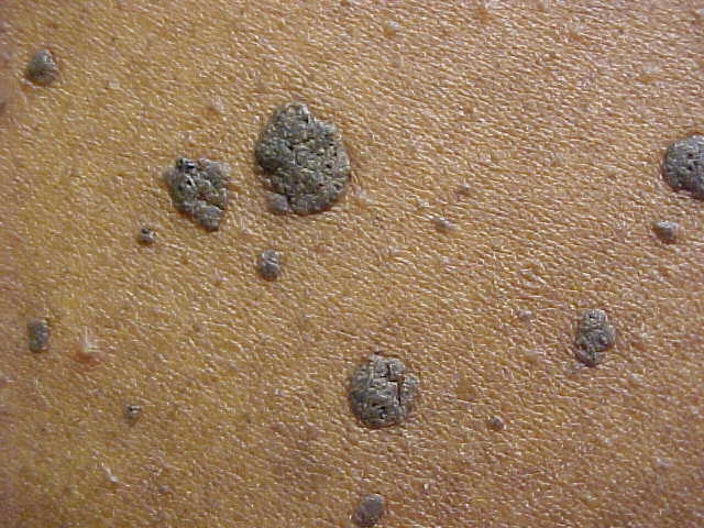 seborrheic keratosis