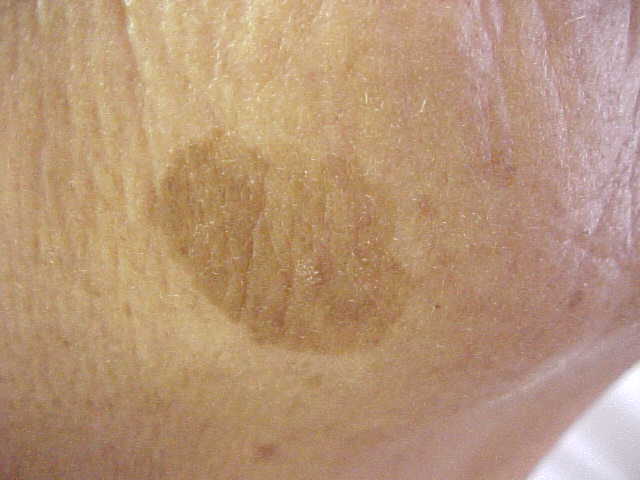 seborrheic keratosis