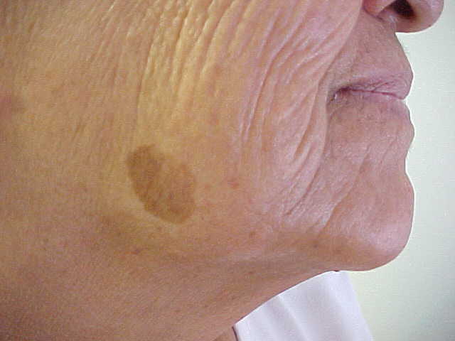 seborrheic keratosis