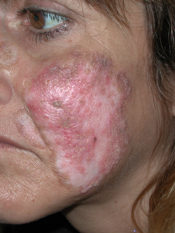 lupus erythematosus, systemic