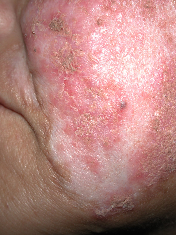 lupus erythematosus, systemic