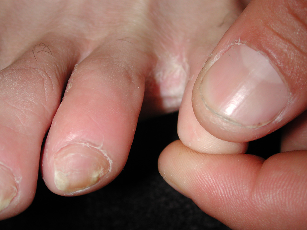 tinea pedis