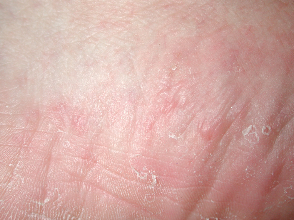 tinea pedis